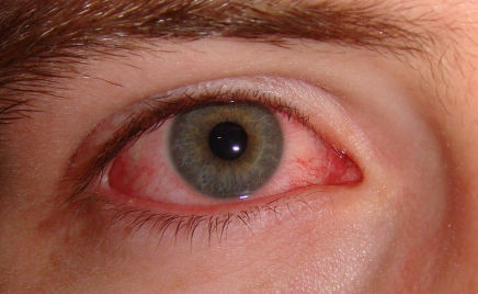 ALERGIA OCULAR