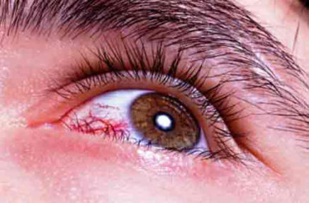 RETINOPATIA DIABÉTICA