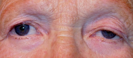 ¿SE LE HAN CAÍDO LOS PÁRPADOS?